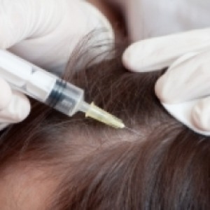 Озонотерапия волосистой части головы